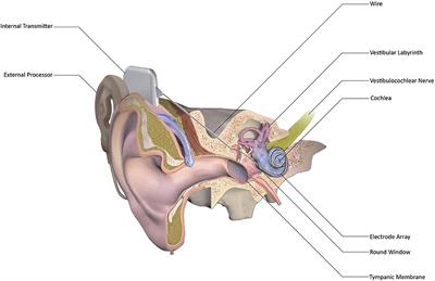 Genotype-Phenotype Correlation for Predicting Cochlear Implant Outcome: Current Challenges and Opportunities